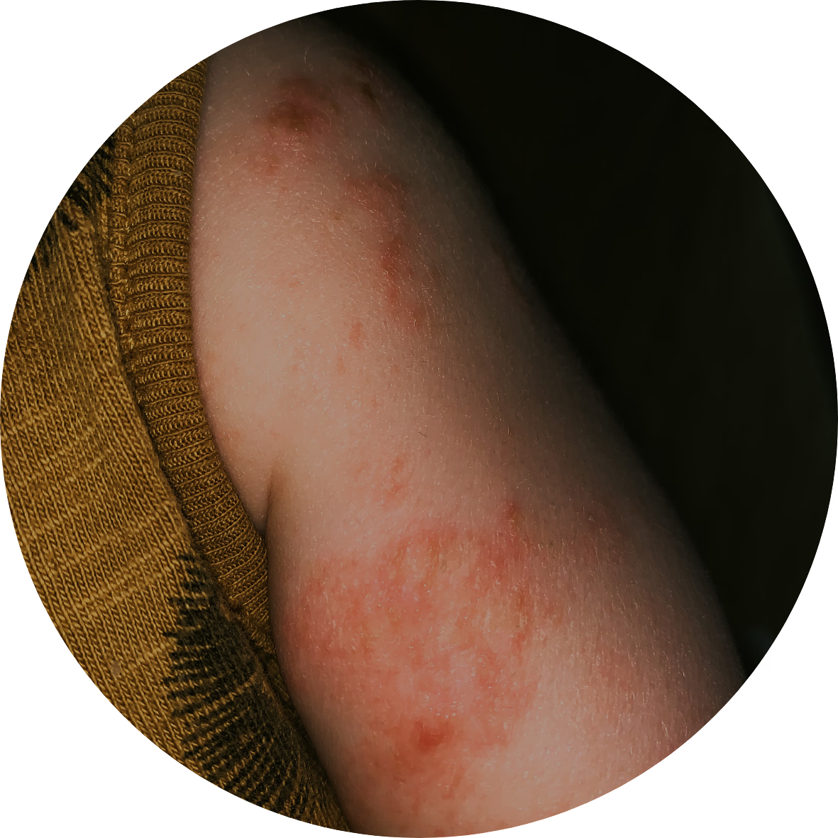 Eczema and Skin Rashes